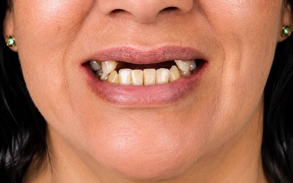 Outro caso de sorriso antes do tratamento