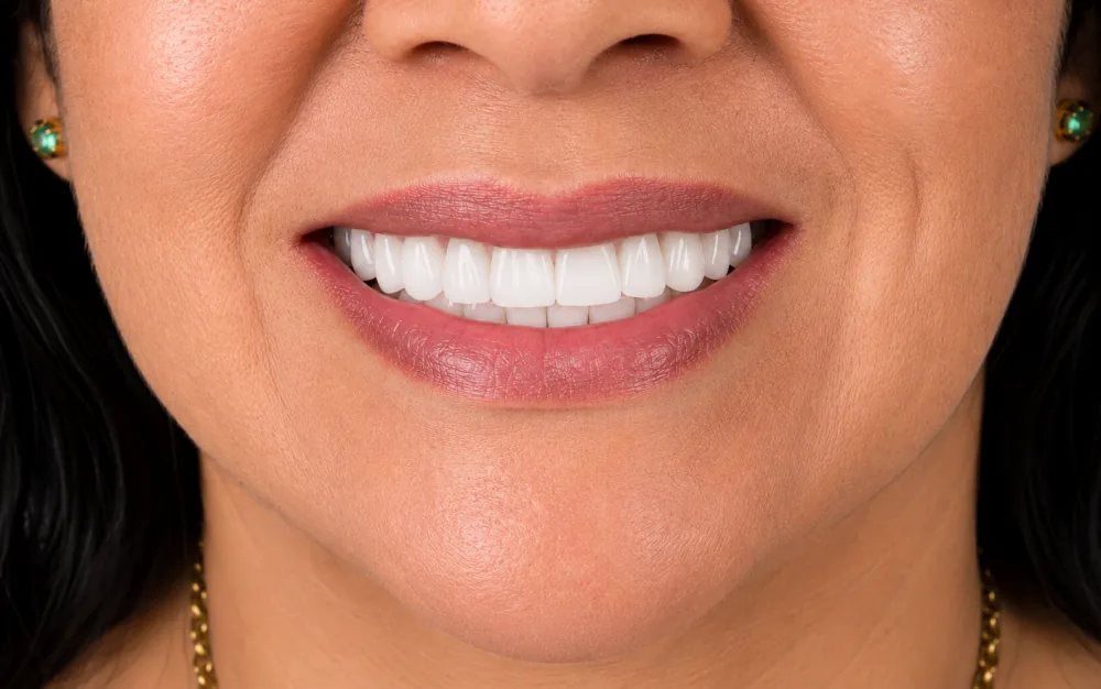 Outro caso de sorriso depois do tratamento na Amorim Odontologia