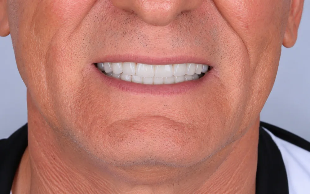 Mais um caso de sorriso depois do tratamento na Amorim Odontologia