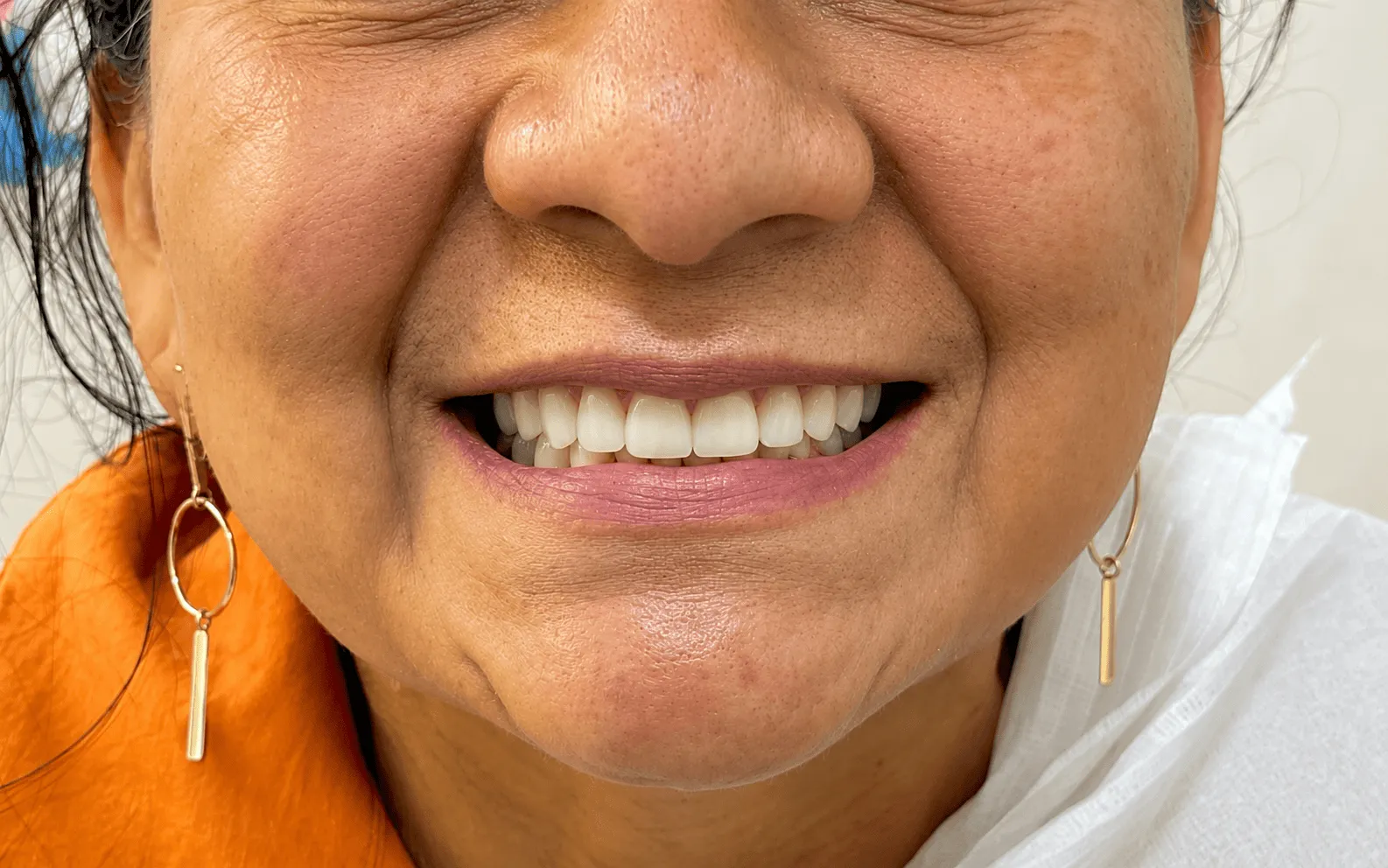 Sorriso depois do tratamento na Amorim Odontologia em Manaus